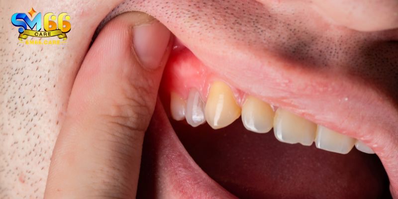 Mơ thấy gãy răng chảy máu có nghĩa là gì?
